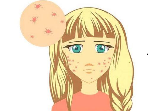 吃瓜长痘了,揭秘饮食与肌肤健康的关系